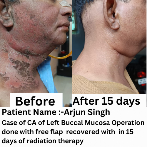 Radiation Skin Burn Treatment in Mumbai, India